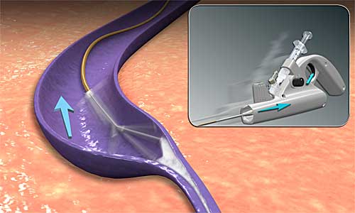 ClariVein