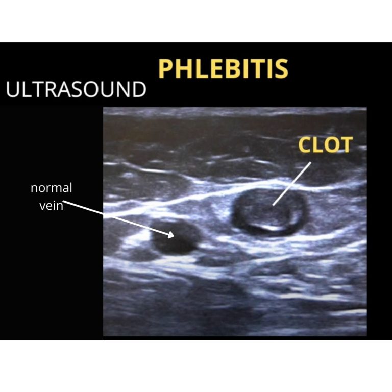What Does Phlebitis of the Leg Look Like with Pictures? The
