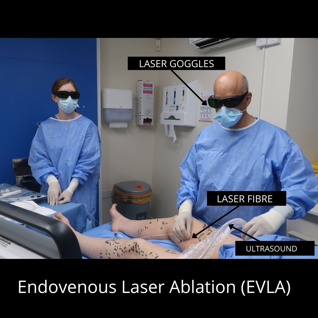 Endovenous Laser Ablation The VeinCare Centre
